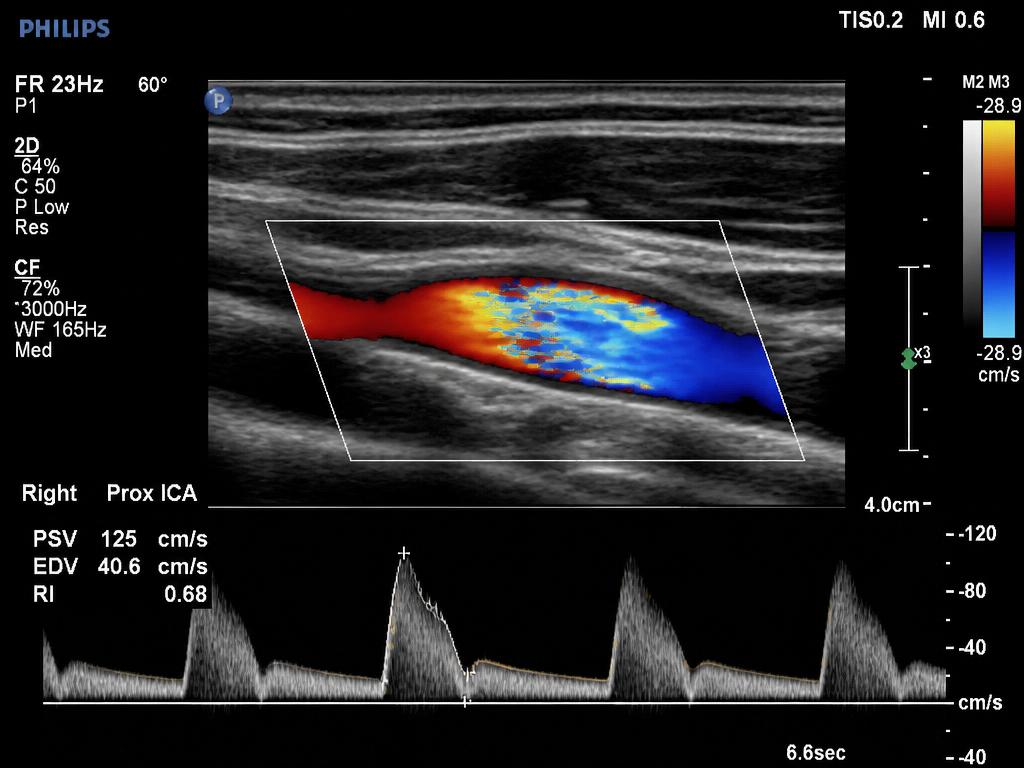 Mapeamento vascular — Doppler Colorido